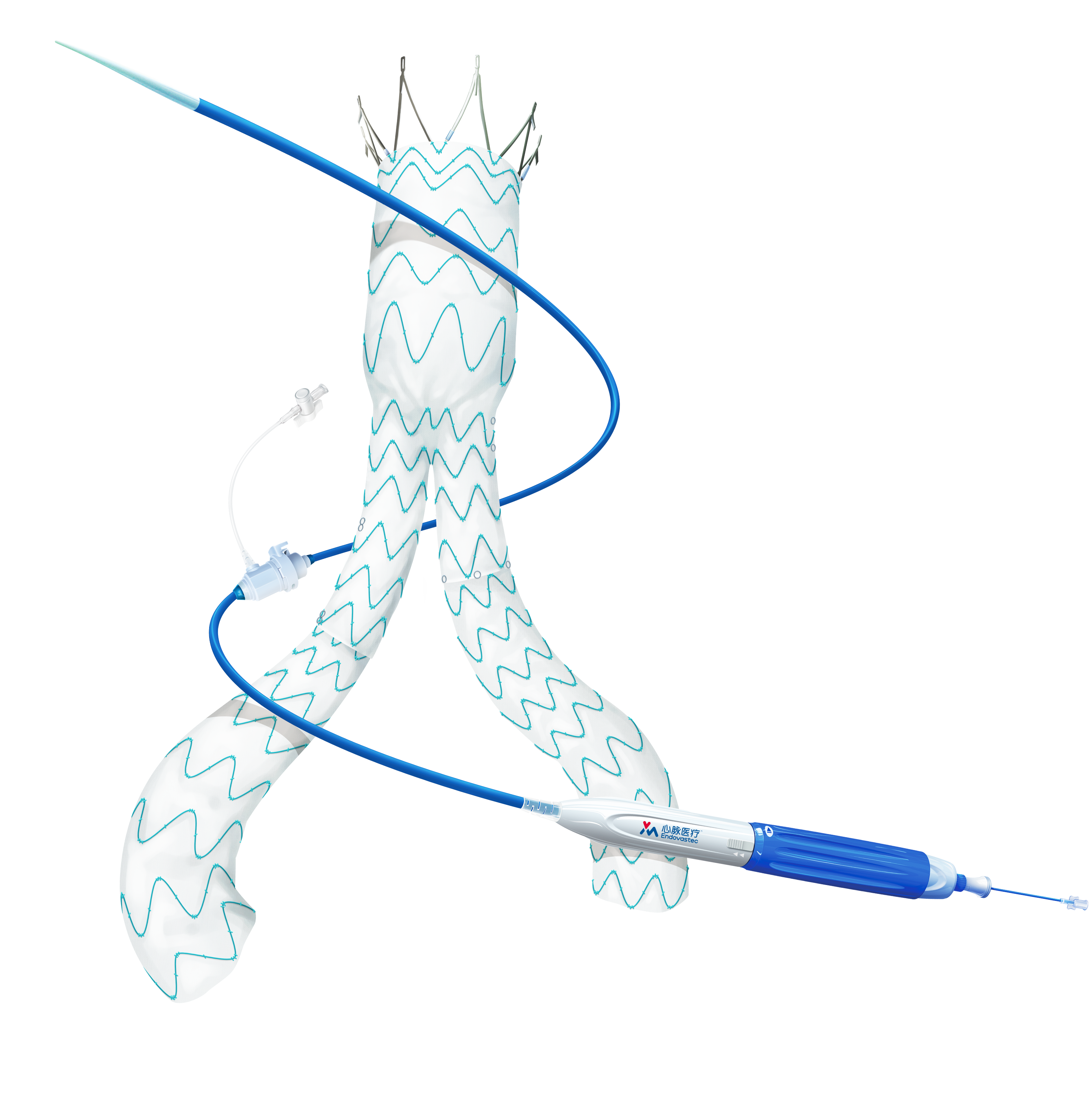 Minos? Abdominal Aortic Stent Graft and Delivery System