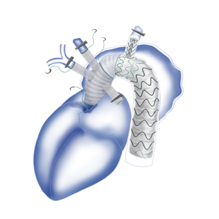 Fontus? Branched Stent Graft System in Surgical Operation